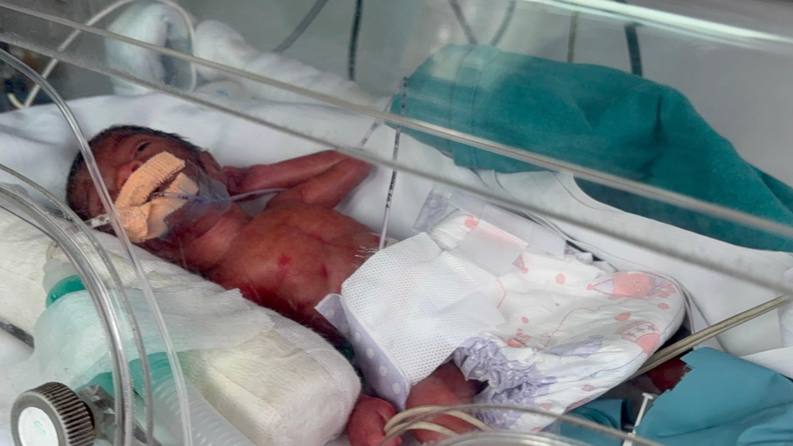 Neonatal Transfer | 26-Week Preterm Twins on Ventilator Support